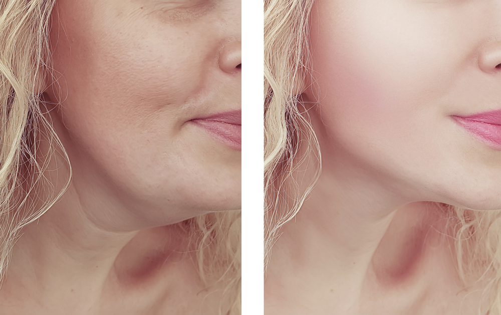 How Many Kybella Sessions Do You Need?