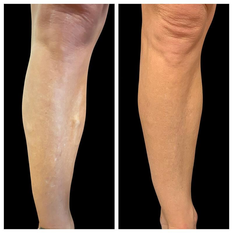 Varicose Vein Treatment Before & After Image