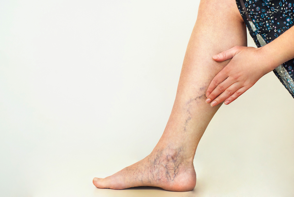 How Can You Get Rid of Varicose Veins?