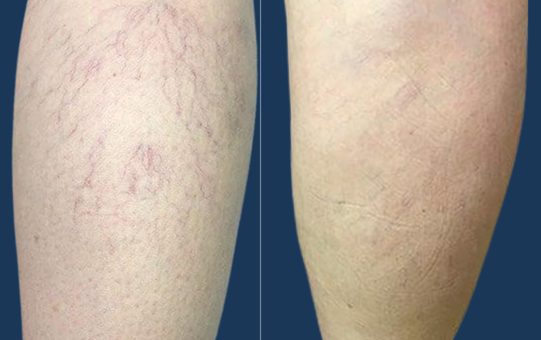 sclerotherapy varicose vein removal