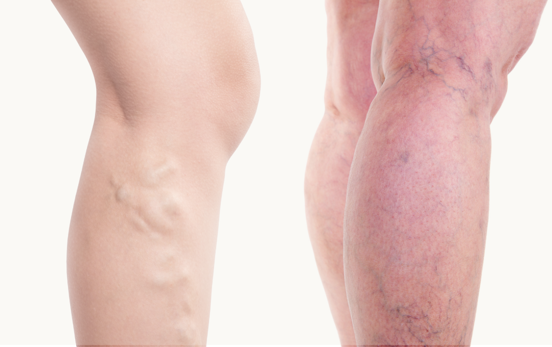 how to treat varicose and spider veins