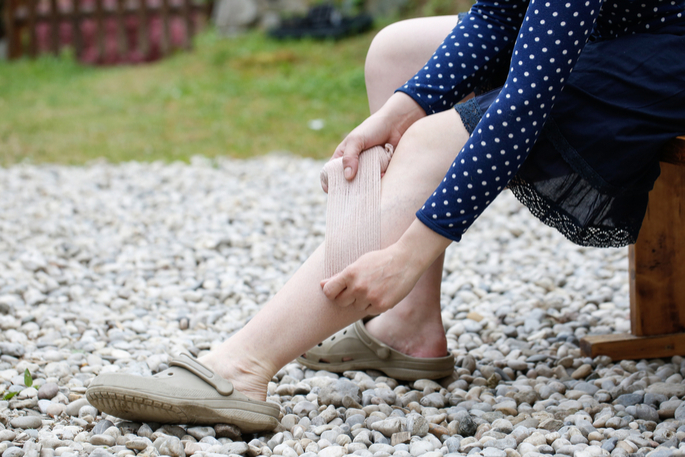 Tackle Your Varicose Veins with Sclerotherapy