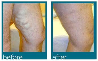 Annapolis vein treatment before and after