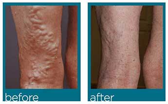 Annapolis vein treatment before and after