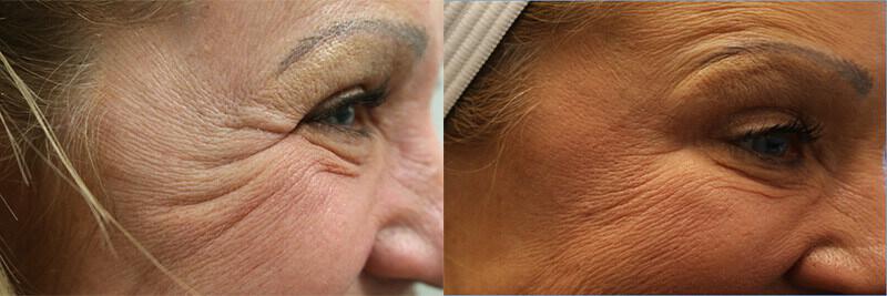 Botox & Dysport Before & After Image