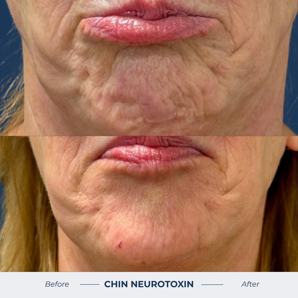 Botox & Dysport Before & After Image