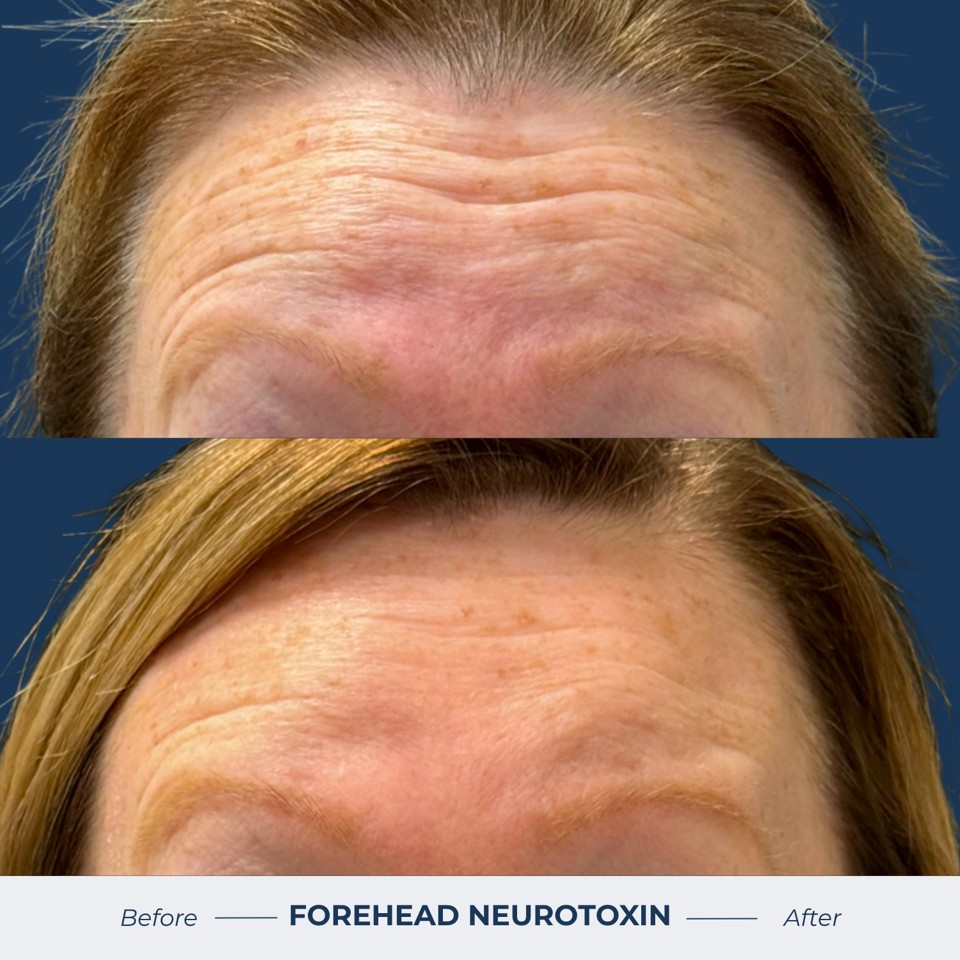 Botox & Dysport Before & After Image