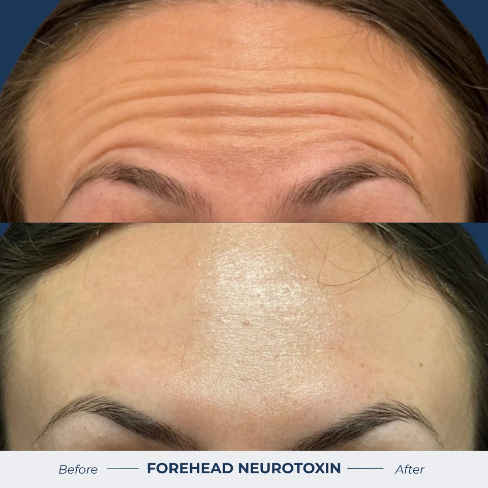 Botox & Dysport Before & After Image