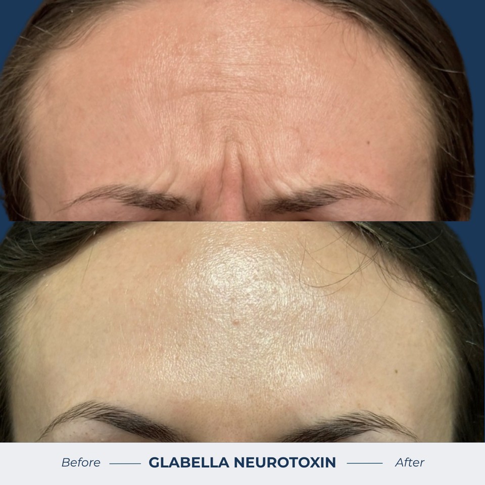 Botox & Dysport Before & After Image