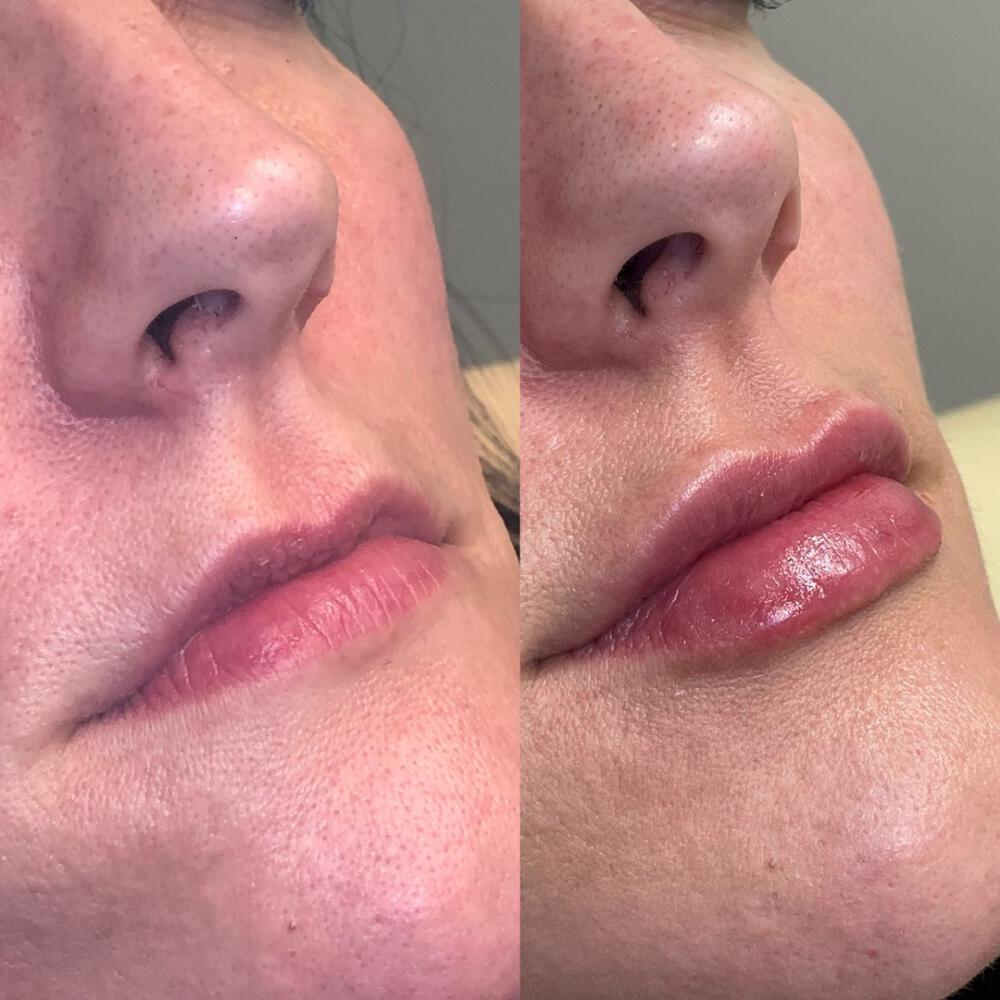 Fillers Before & After Image