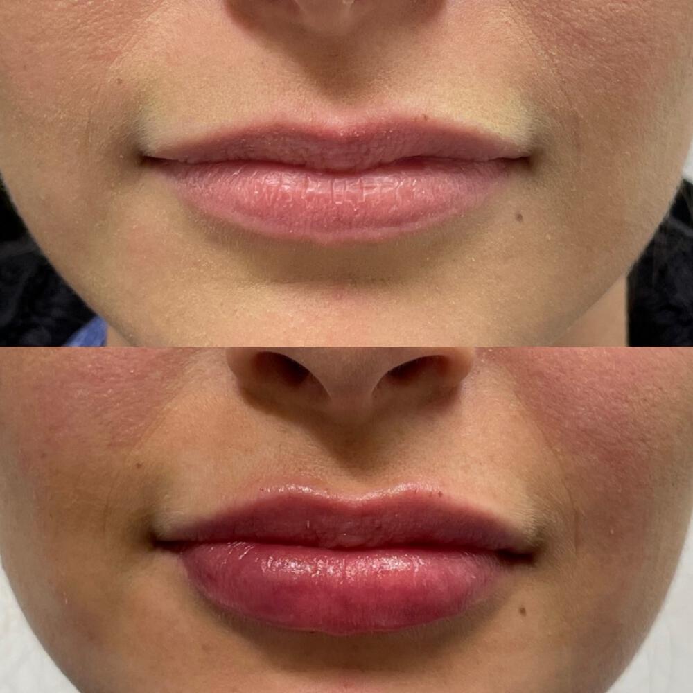 Fillers Before & After Image