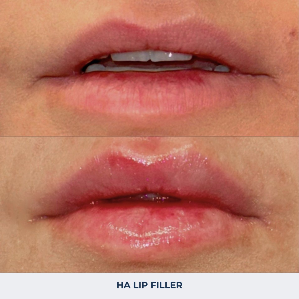 Fillers Before & After Image