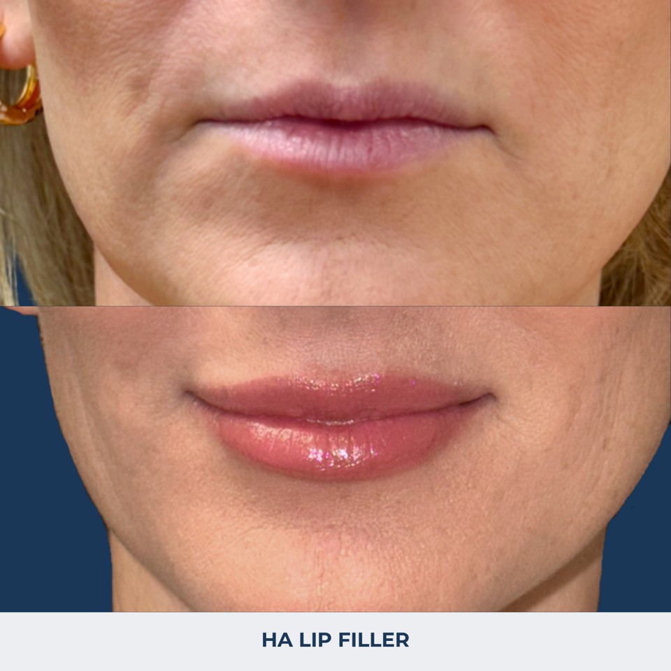 Fillers Before & After Image