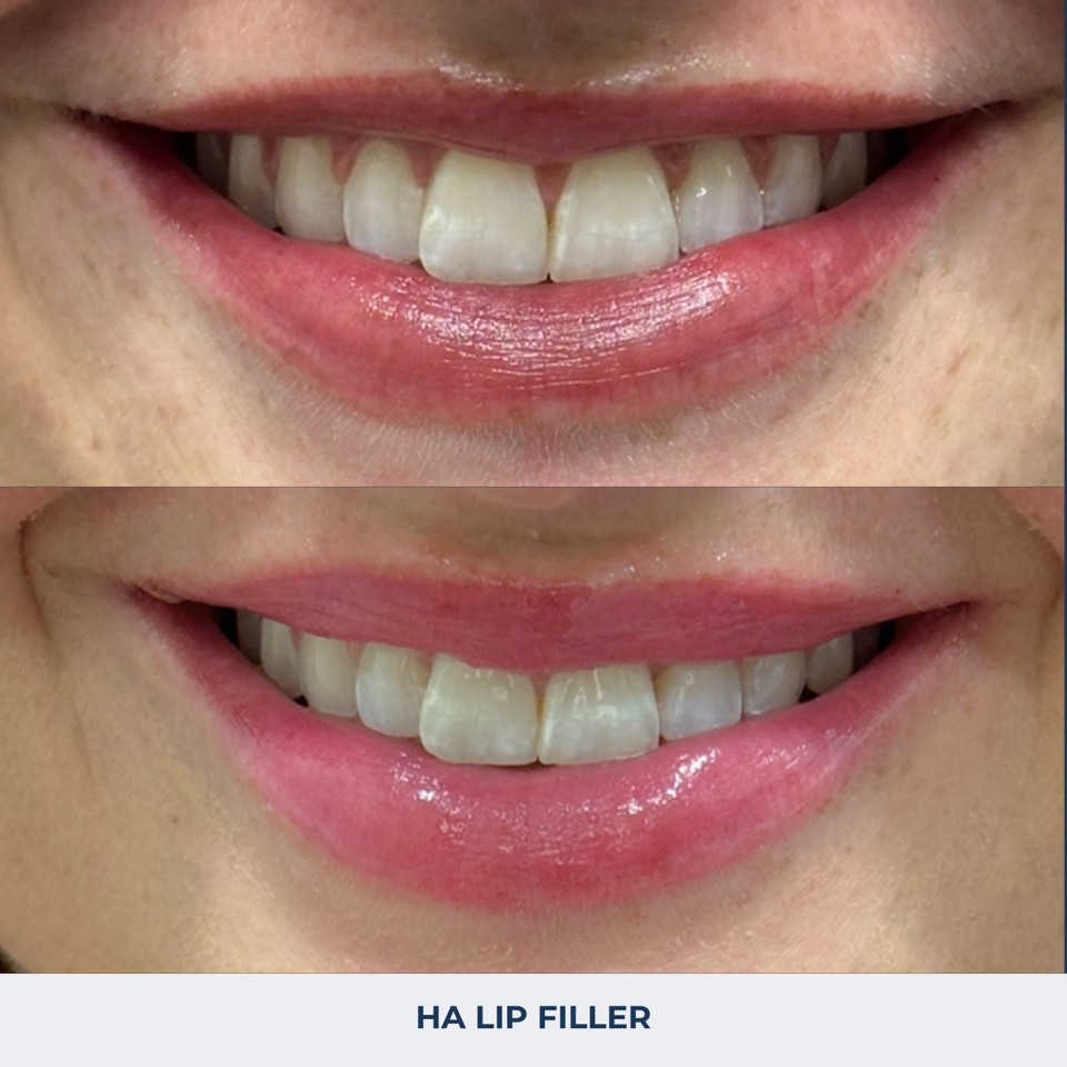 Fillers Before & After Image