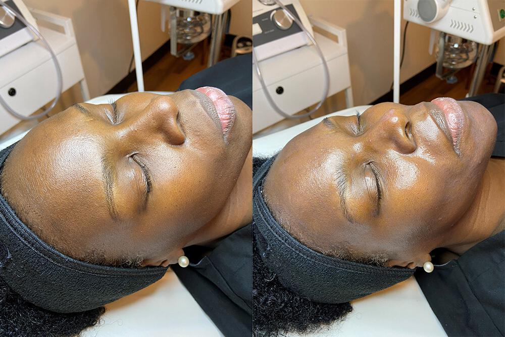 Skincare Services Before & After Image