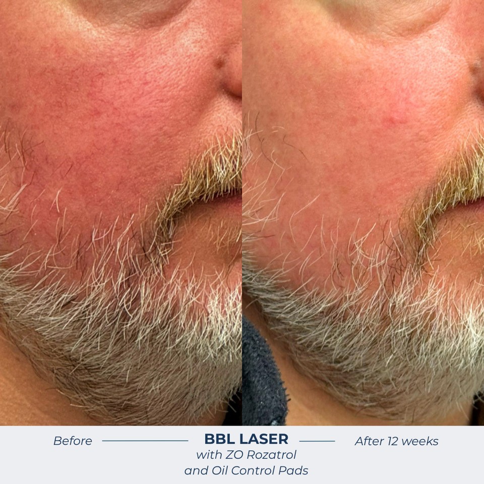 Broad Band Light Before & After Image