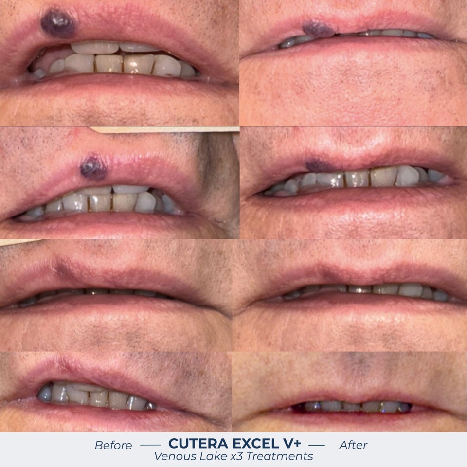 excel® V | Cutera Before & After Image