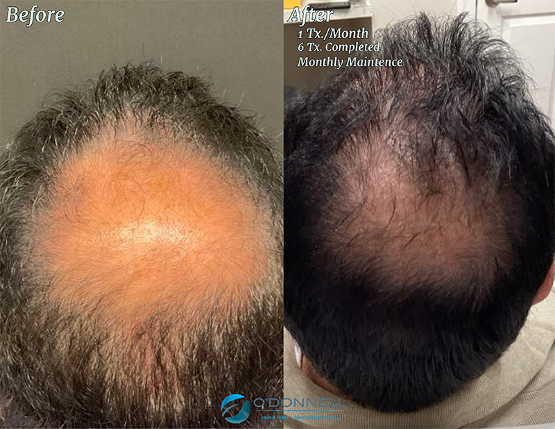 Hair Restoration (Keralase) Before & After Image