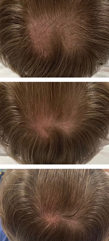 Hair Restoration (Keralase) Before & After Image