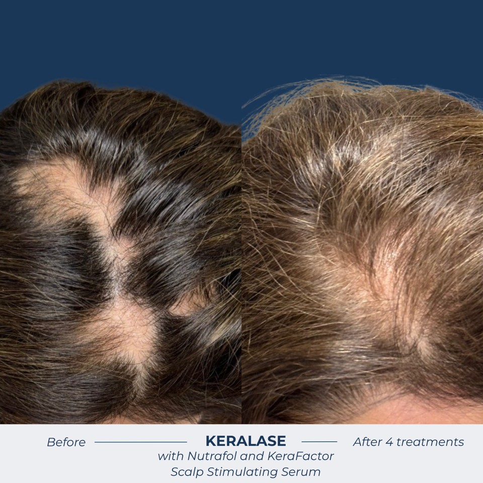 Hair Restoration (Keralase) Before & After Image