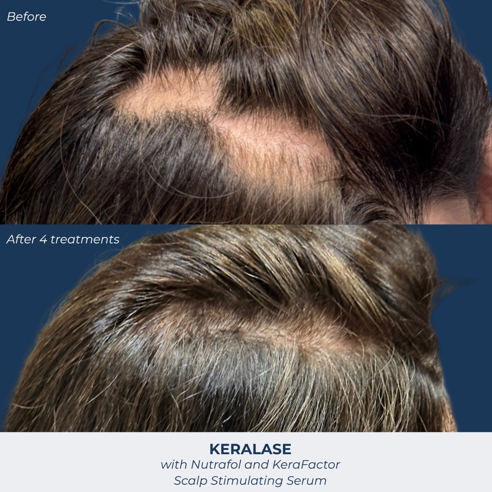 Hair Restoration (Keralase) Before & After Image
