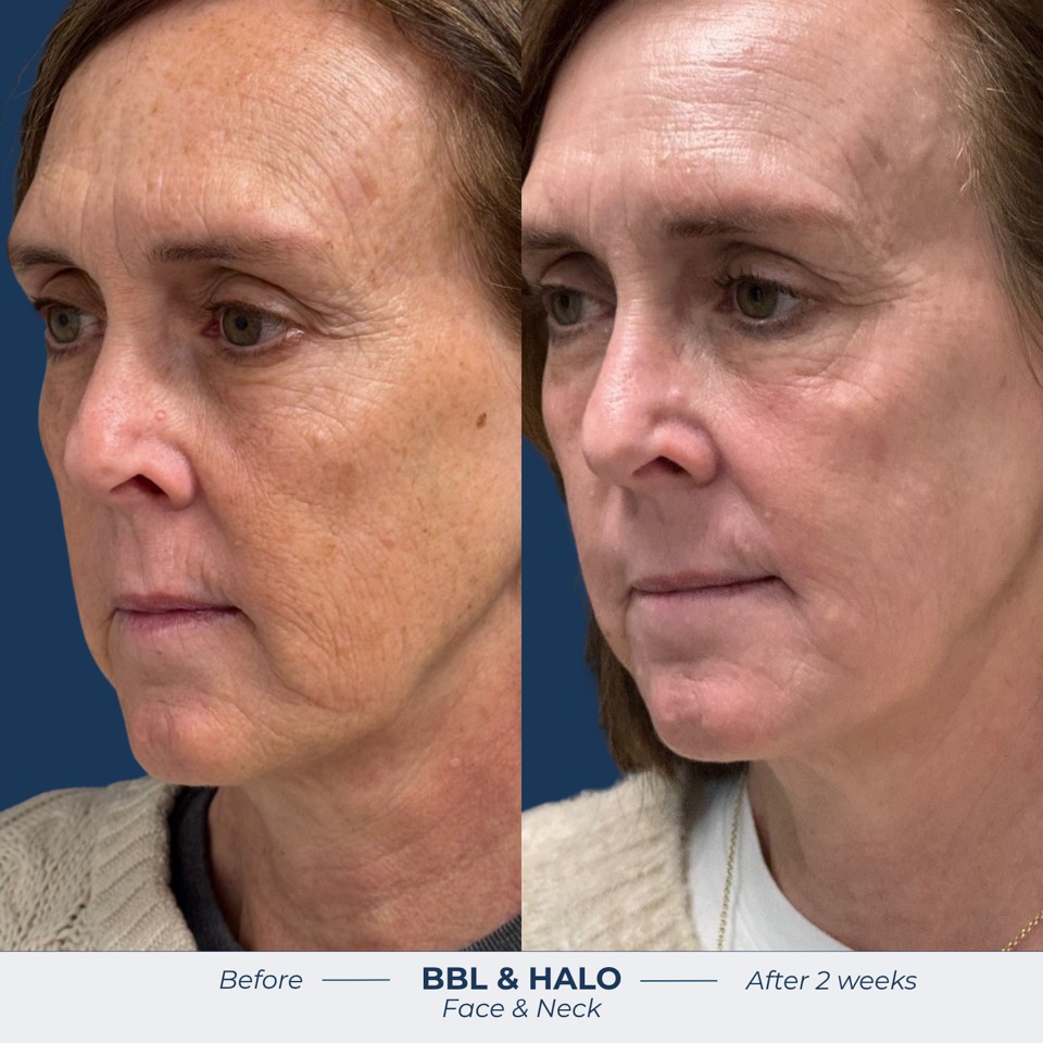 Halo Before & After Image