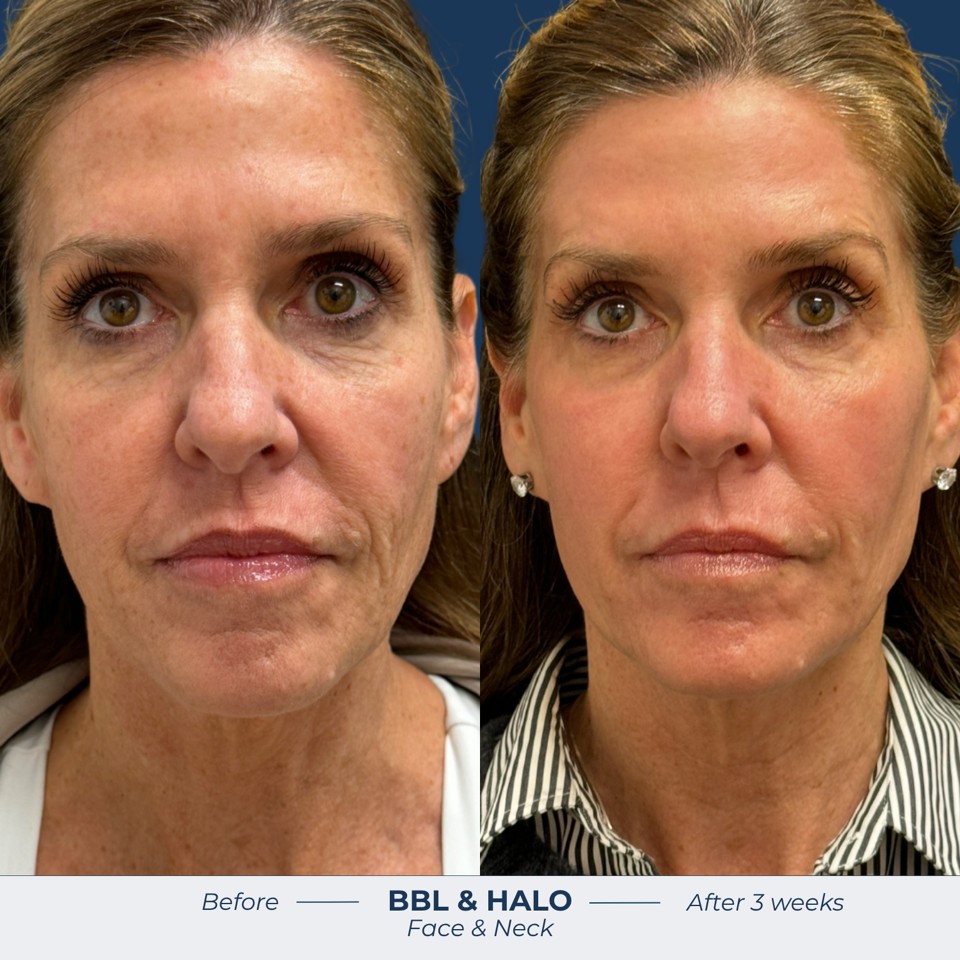 Halo Before & After Image