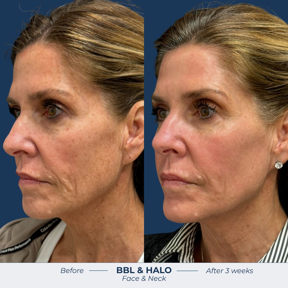 Halo Before & After Image