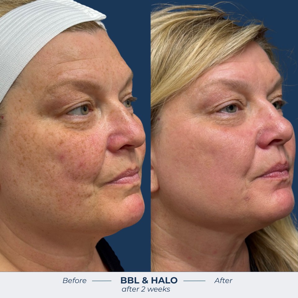 Halo Before & After Image
