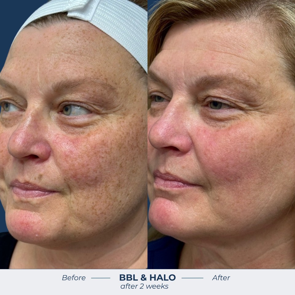 Halo Before & After Image