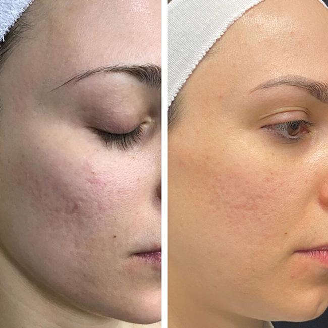 Microlaser Peel  Before & After Image