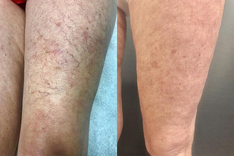 Sclerotherapy Before & After Image