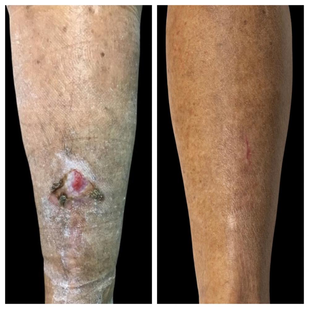 Wound Healing Before & After Image