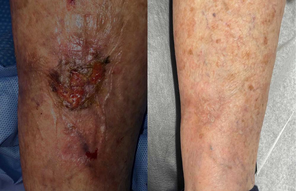Wound Healing Before & After Image
